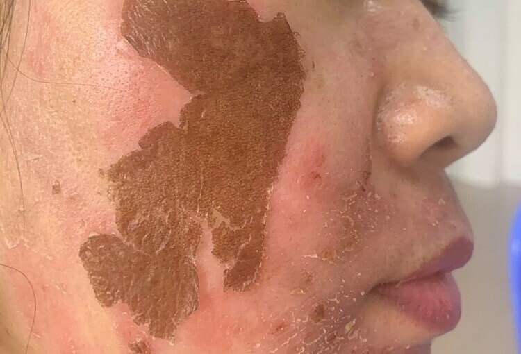 Peel da tại nhà dễ gây nên bỏng da nếu thực hiện sai cách.
