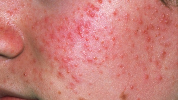 Da mỏng yếu, dễ kích ứng và viêm sưng khi peel da tại nhà.